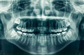 Panoramic dental X-ray preview